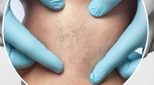 Σκληροθεραπεία: Μια αξιόπιστη λύση για την εξάλειψη των ευρυαγγειών