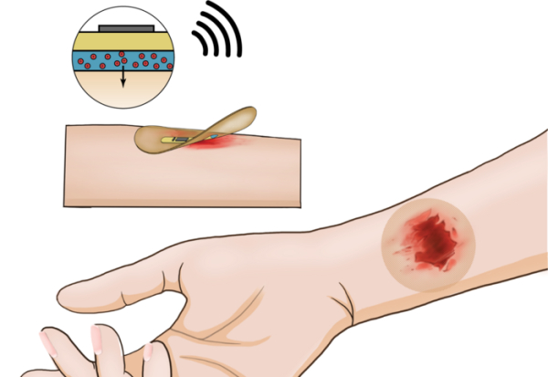 «Έξυπνος» ασύρματος επίδεσμος υπόσχεται γρήγορη επούλωση χρόνιων πληγών
